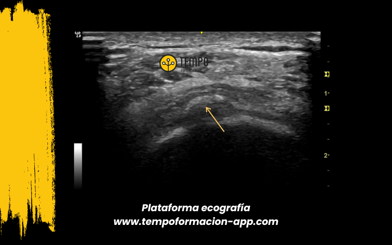 8. Ecografia tempo formacion manguito rotador tendon supraespinoso infraespinoso redondo menor subescapular.png